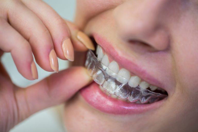 Invisalign vs. Braces – Why Invisalign is the Modern Choice